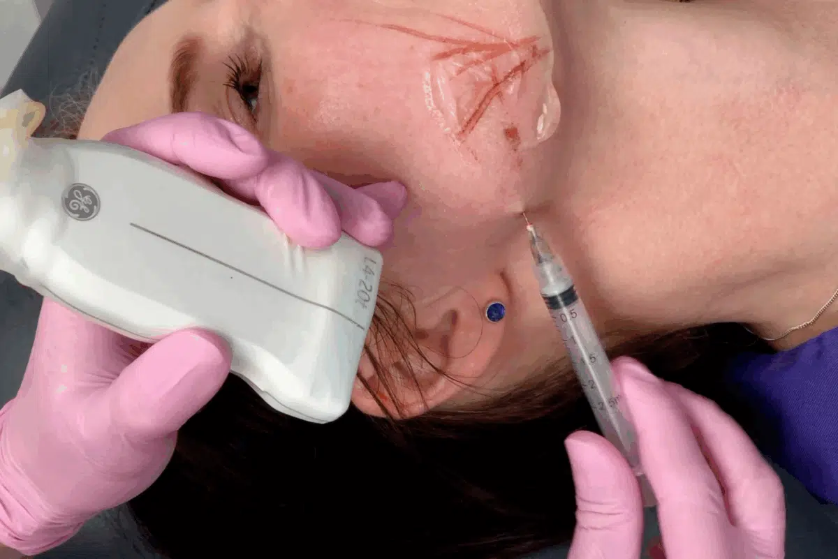 Skulptra – Innovative Dermal Filler bei MorySkin erhältlich